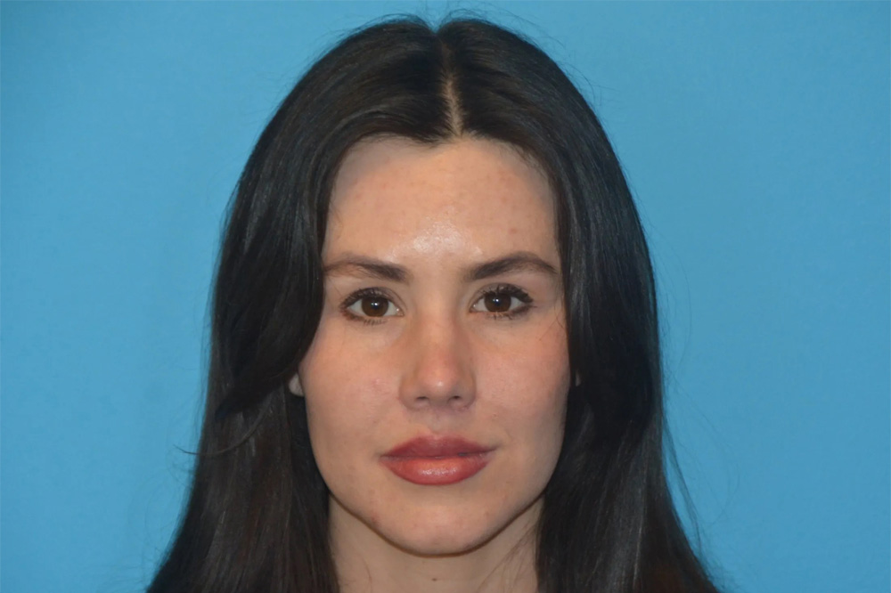 Lip Lift Real Patient Results by Dr. Scott Urban in Salt Lake City, Utah