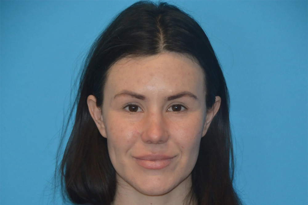 Lip Lift Real Patient Results by Dr. Scott Urban in Salt Lake City, Utah