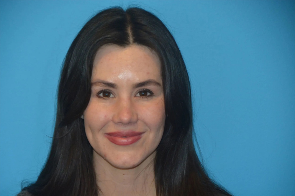 Lip Lift Real Patient Results by Dr. Scott Urban in Salt Lake City, Utah