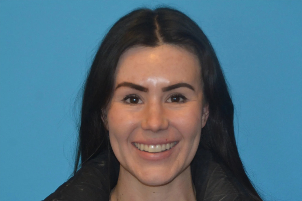 Lip Lift Real Patient Results by Dr. Scott Urban in Salt Lake City, Utah