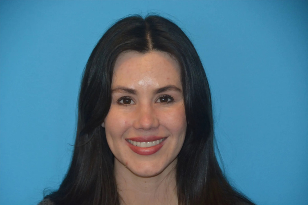 Lip Lift Real Patient Results by Dr. Scott Urban in Salt Lake City, Utah