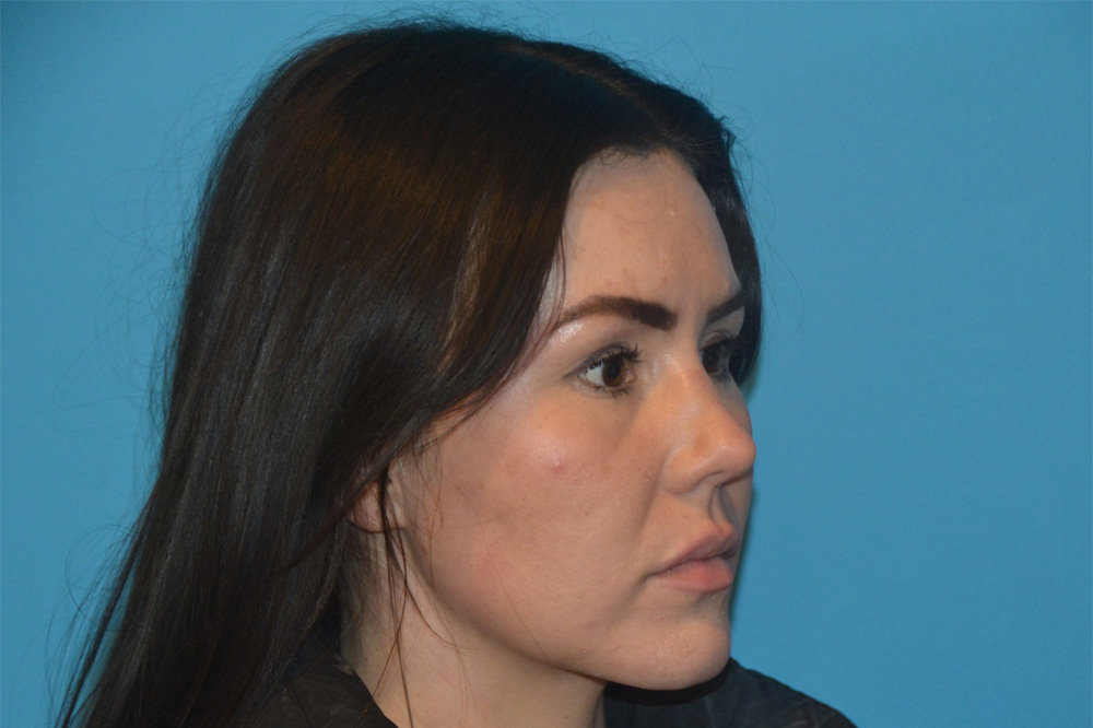 Lip Lift Real Patient Results by Dr. Scott Urban in Salt Lake City, Utah