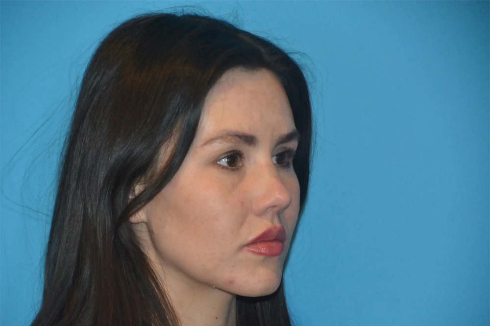 Lip Lift Real Patient Results by Dr. Scott Urban in Salt Lake City, Utah