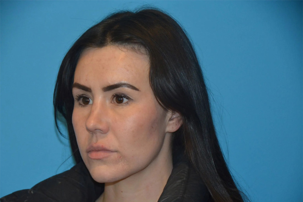 Lip Lift Real Patient Results by Dr. Scott Urban in Salt Lake City, Utah