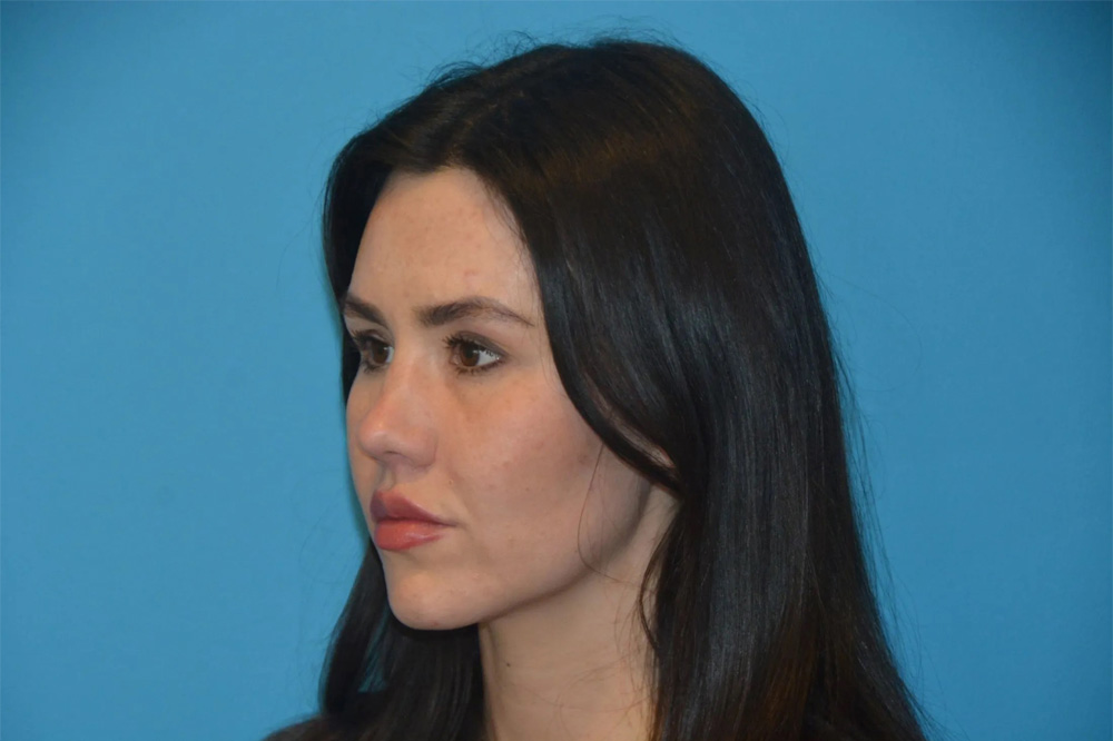 Lip Lift Real Patient Results by Dr. Scott Urban in Salt Lake City, Utah