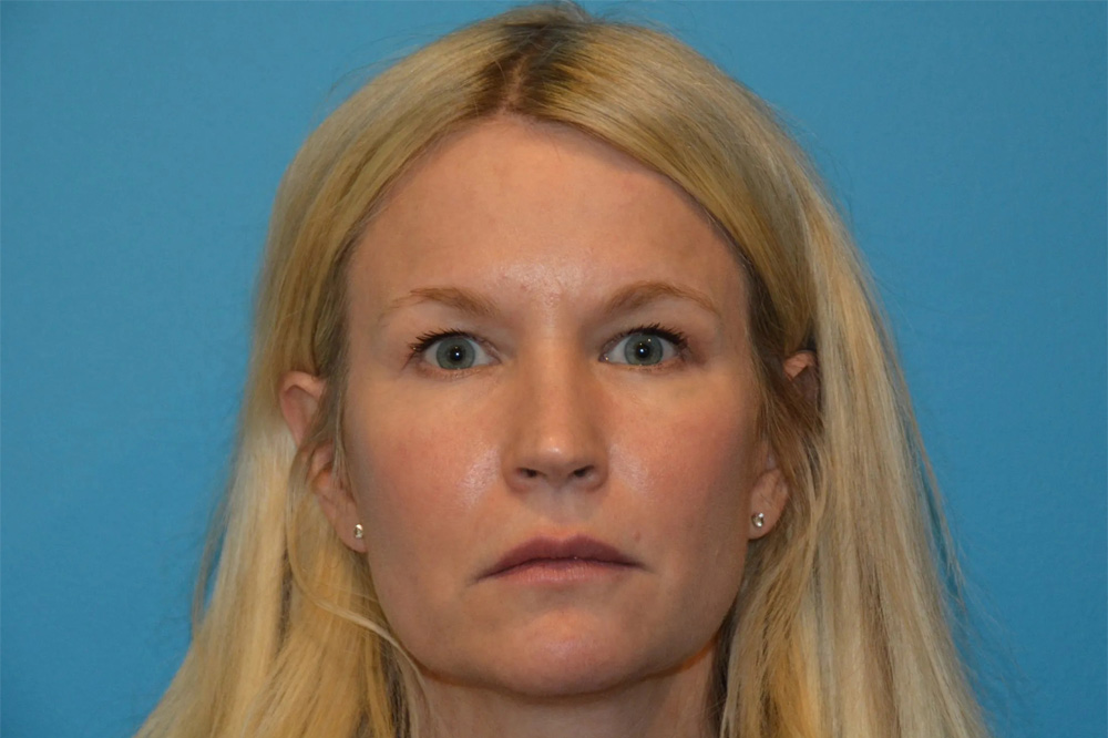 Lip Lift Real Patient Results by Dr. Scott Urban in Salt Lake City, Utah