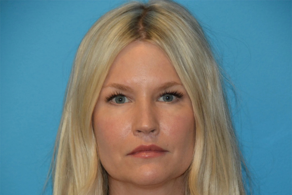 Lip Lift Real Patient Results by Dr. Scott Urban in Salt Lake City, Utah