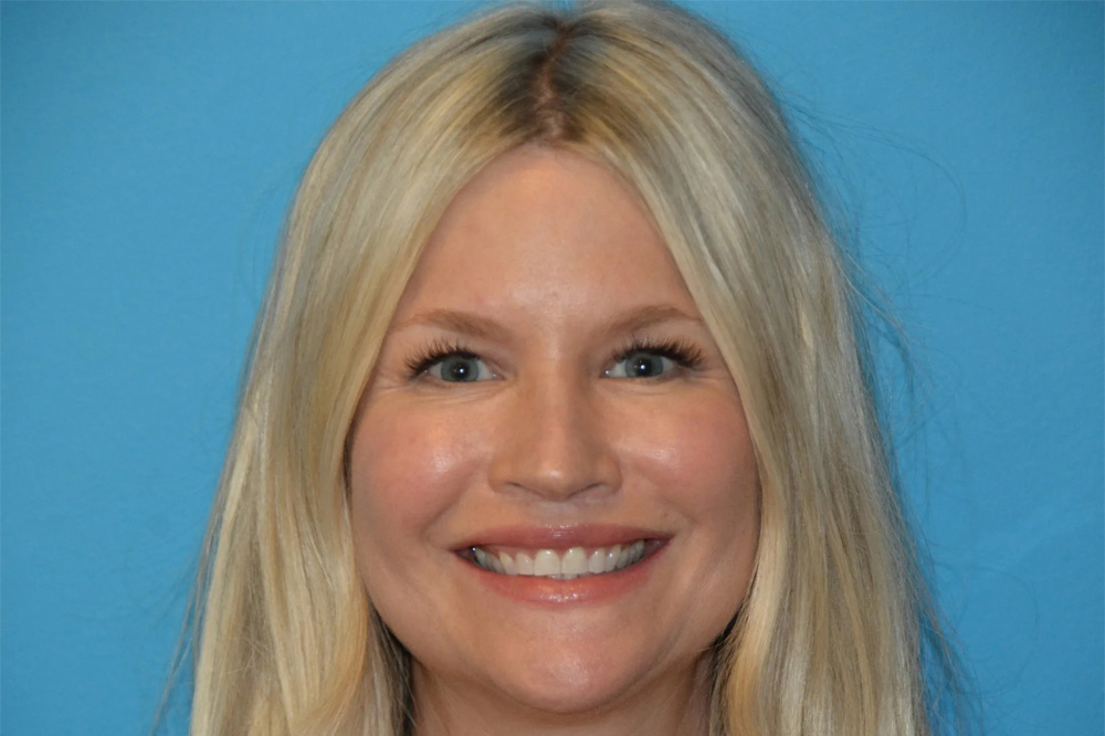 Lip Lift Real Patient Results by Dr. Scott Urban in Salt Lake City, Utah