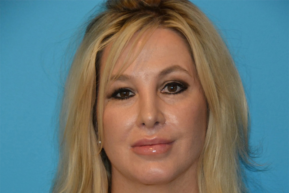 Lip Lift Real Patient Results by Dr. Scott Urban in Salt Lake City, Utah