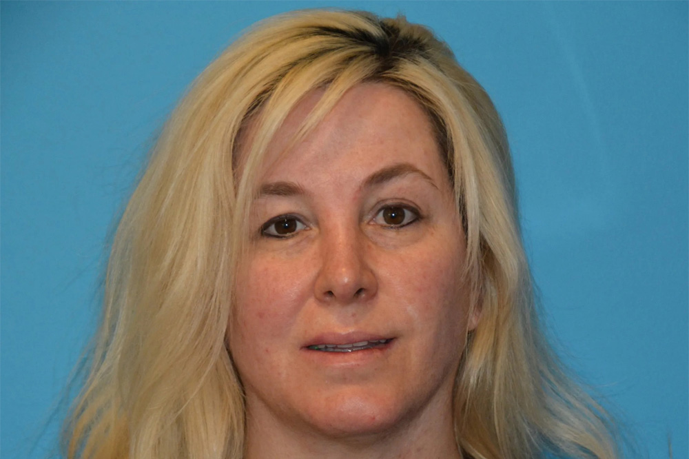 Lip Lift Real Patient Results by Dr. Scott Urban in Salt Lake City, Utah