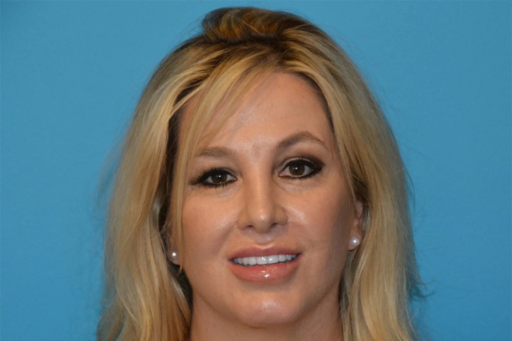 Lip Lift Real Patient Results by Dr. Scott Urban in Salt Lake City, Utah