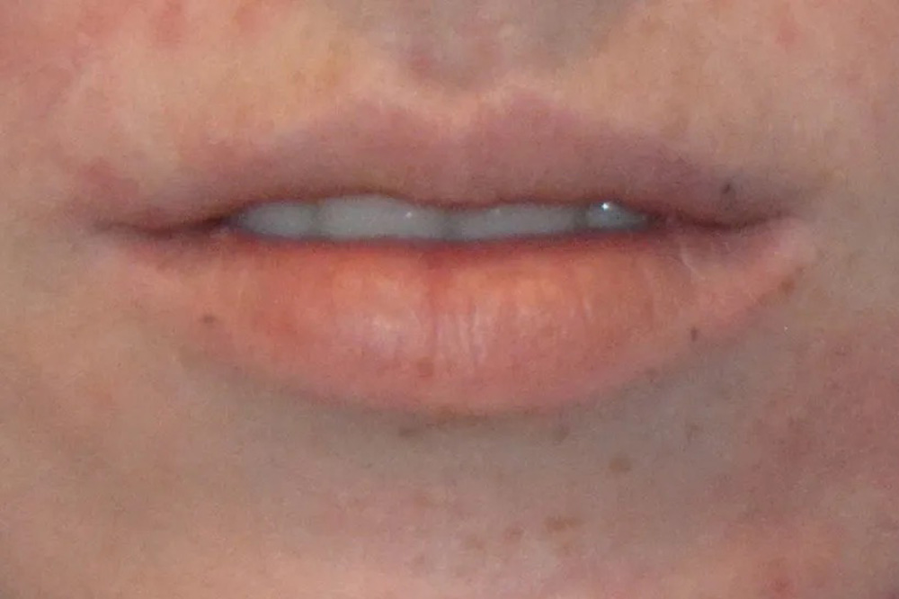 Lip Lift Real Patient Results by Dr. Scott Urban in Salt Lake City, Utah