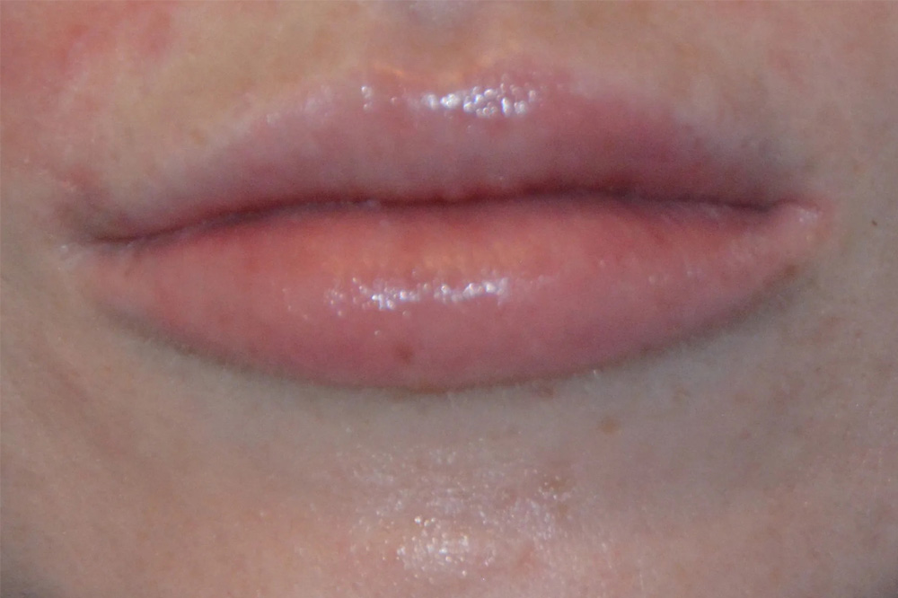 Lip Lift Real Patient Results by Dr. Scott Urban in Salt Lake City, Utah