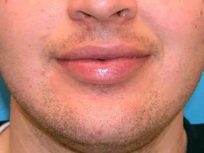 Lip Lift Real Patient Results by Dr. Scott Urban in Salt Lake City, Utah