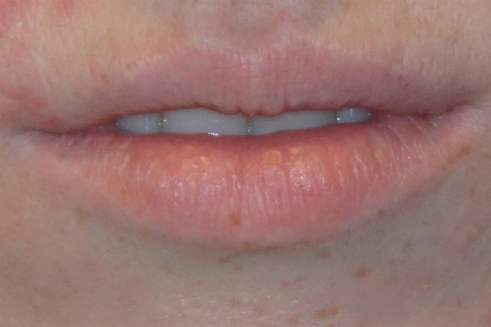 Lip Lift Real Patient Results by Dr. Scott Urban in Salt Lake City, Utah