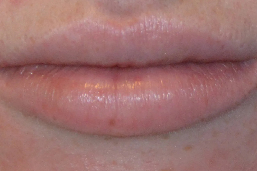 Lip Lift Real Patient Results by Dr. Scott Urban in Salt Lake City, Utah