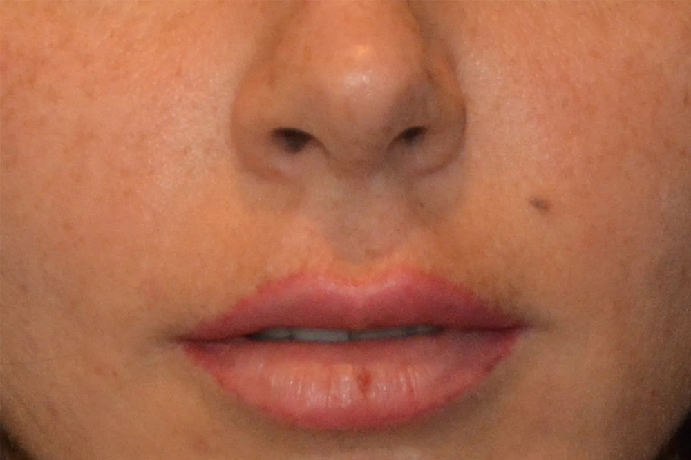 Lip Lift Real Patient Results by Dr. Scott Urban in Salt Lake City, Utah