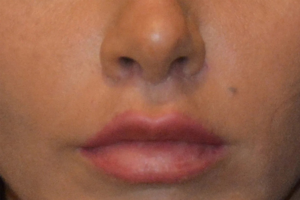 Lip Lift Real Patient Results by Dr. Scott Urban in Salt Lake City, Utah