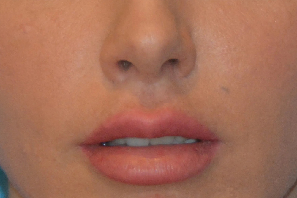 Lip Lift Real Patient Results by Dr. Scott Urban in Salt Lake City, Utah