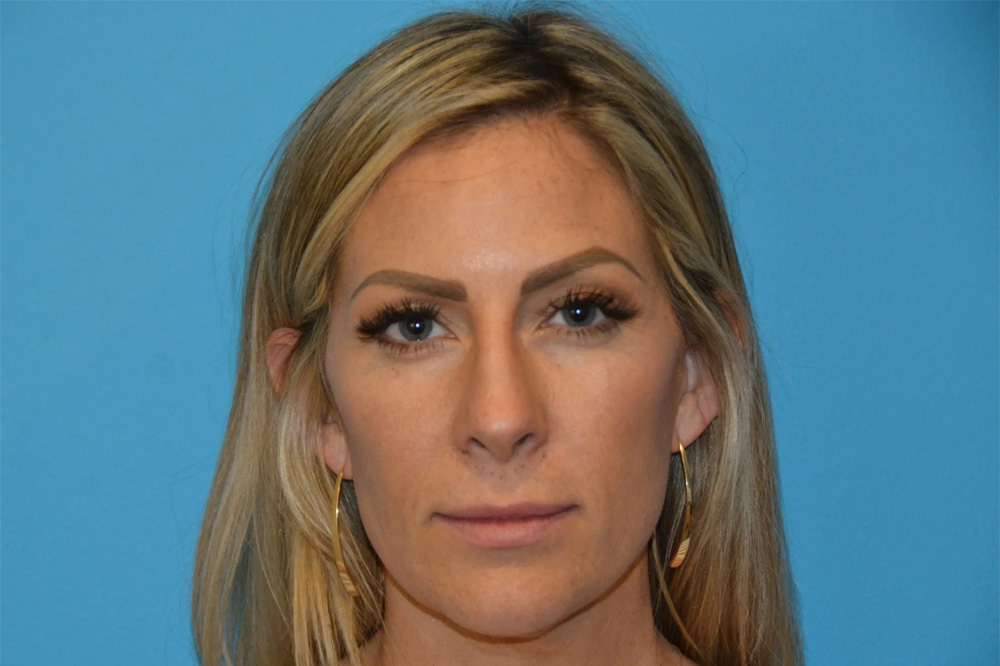 Lip Lift Real Patient Results by Dr. Scott Urban in Salt Lake City, Utah