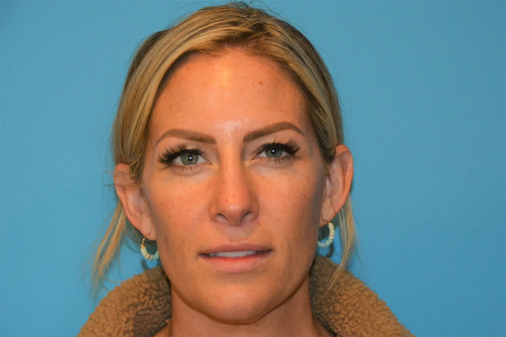 Lip Lift Real Patient Results by Dr. Scott Urban in Salt Lake City, Utah