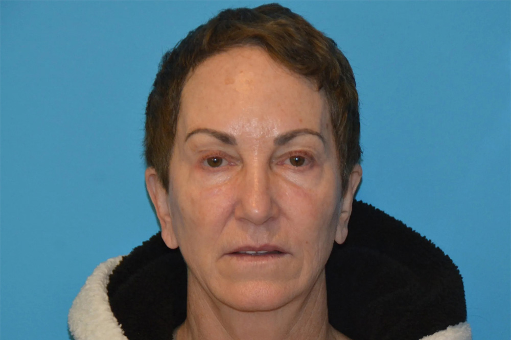 Lip Lift Real Patient Results by Dr. Scott Urban in Salt Lake City, Utah