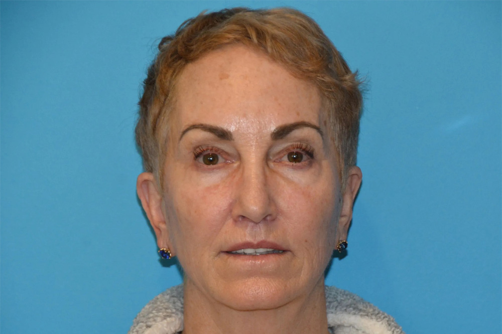 Lip Lift Real Patient Results by Dr. Scott Urban in Salt Lake City, Utah