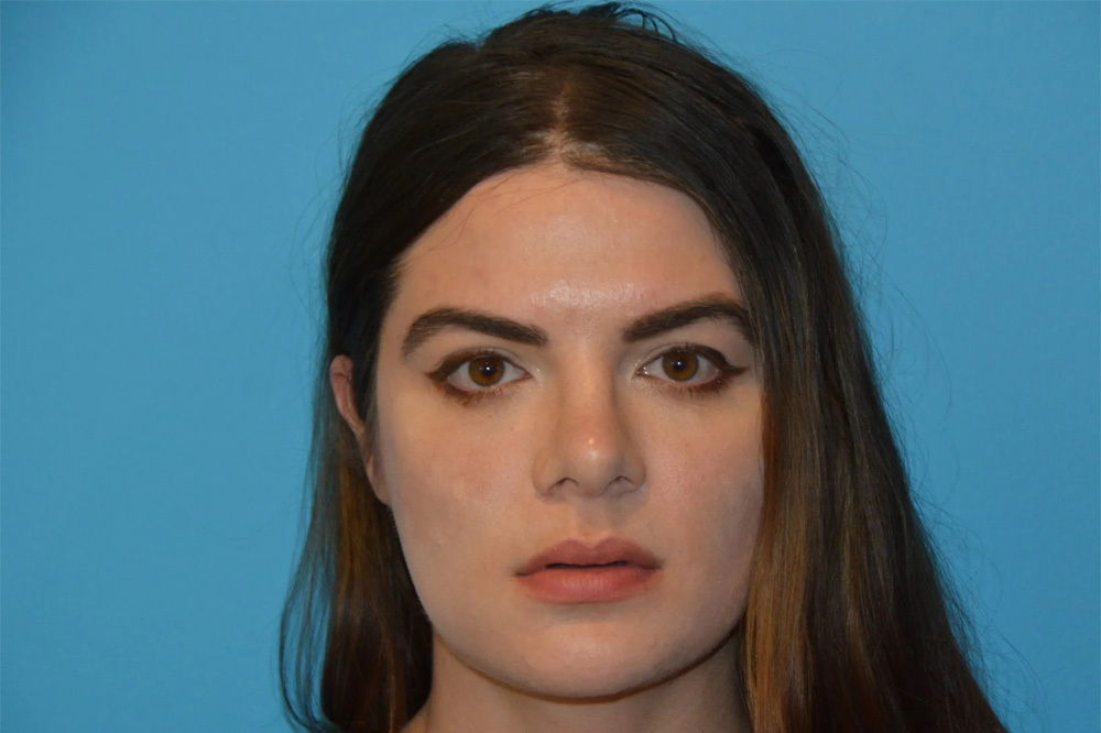 Lip Lift Real Patient Results by Dr. Scott Urban in Salt Lake City, Utah