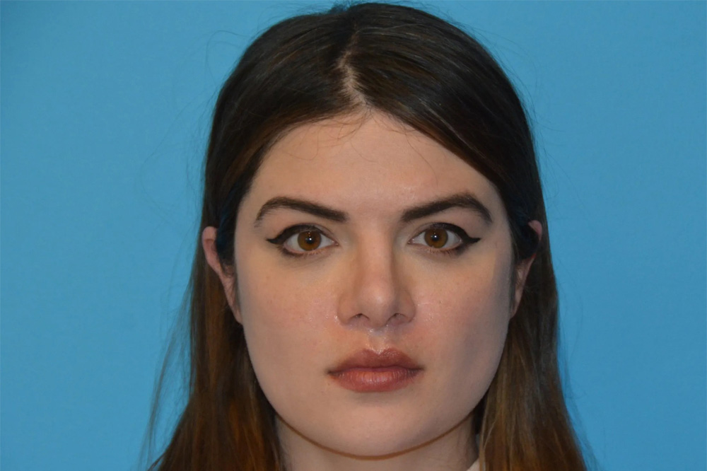 Lip Lift Real Patient Results by Dr. Scott Urban in Salt Lake City, Utah