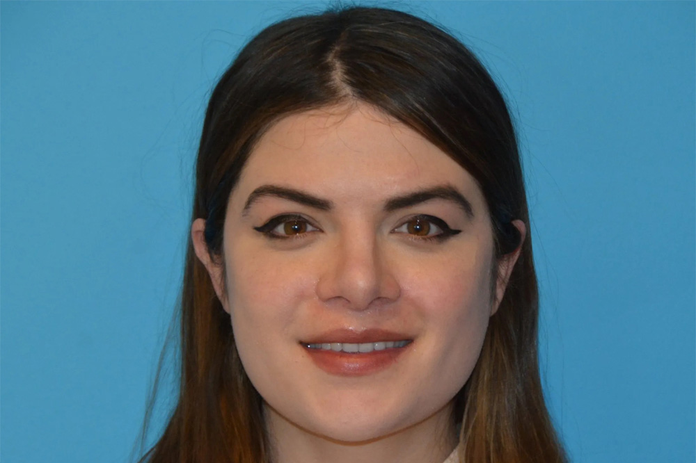 Lip Lift Real Patient Results by Dr. Scott Urban in Salt Lake City, Utah