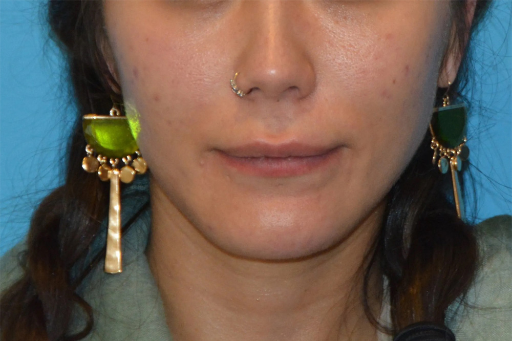 Lip Lift Real Patient Results by Dr. Scott Urban in Salt Lake City, Utah