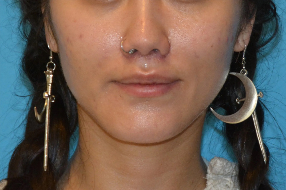 Lip Lift Real Patient Results by Dr. Scott Urban in Salt Lake City, Utah