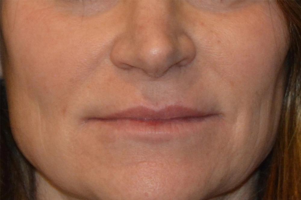 Lip Lift Real Patient Results by Dr. Scott Urban in Salt Lake City, Utah