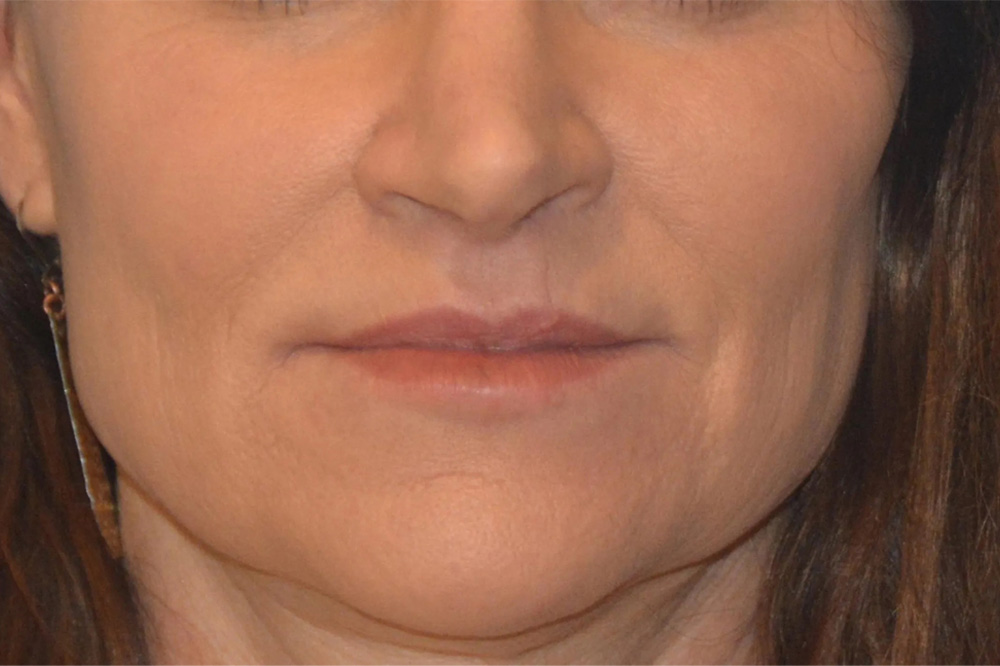 Lip Lift Real Patient Results by Dr. Scott Urban in Salt Lake City, Utah