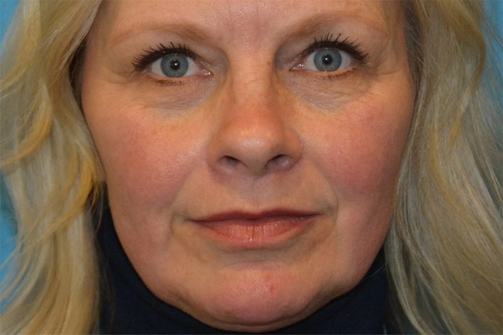 Lip Lift Real Patient Results by Dr. Scott Urban in Salt Lake City, Utah