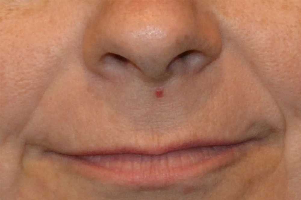 Lip Lift Real Patient Results by Dr. Scott Urban in Salt Lake City, Utah