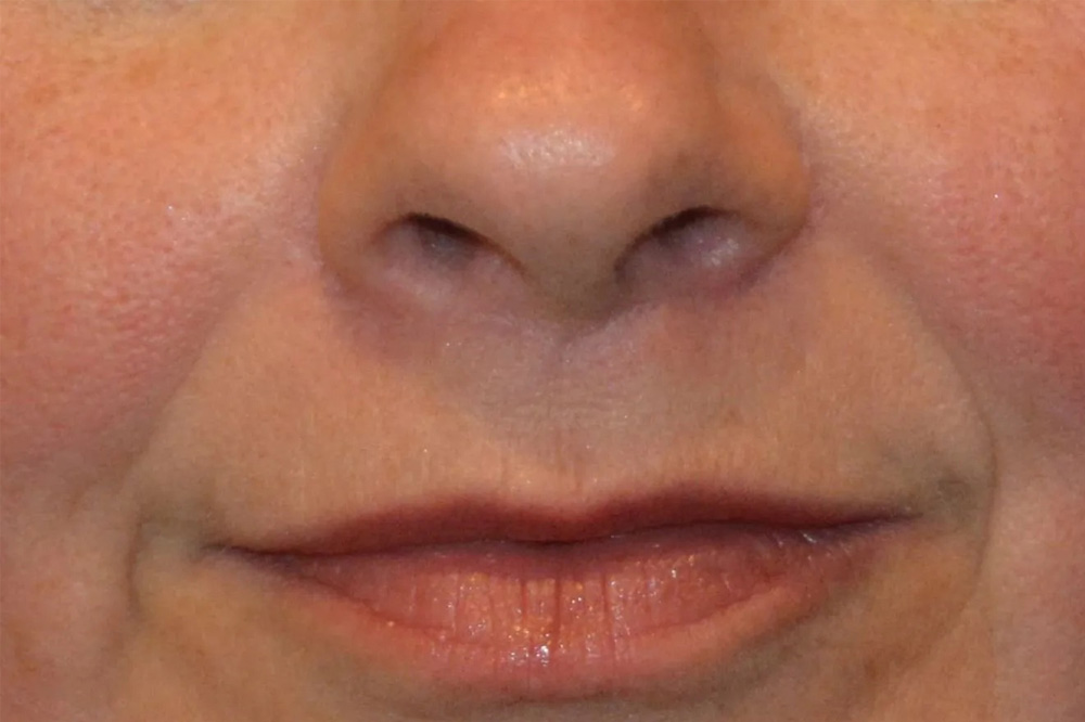 Lip Lift Real Patient Results by Dr. Scott Urban in Salt Lake City, Utah