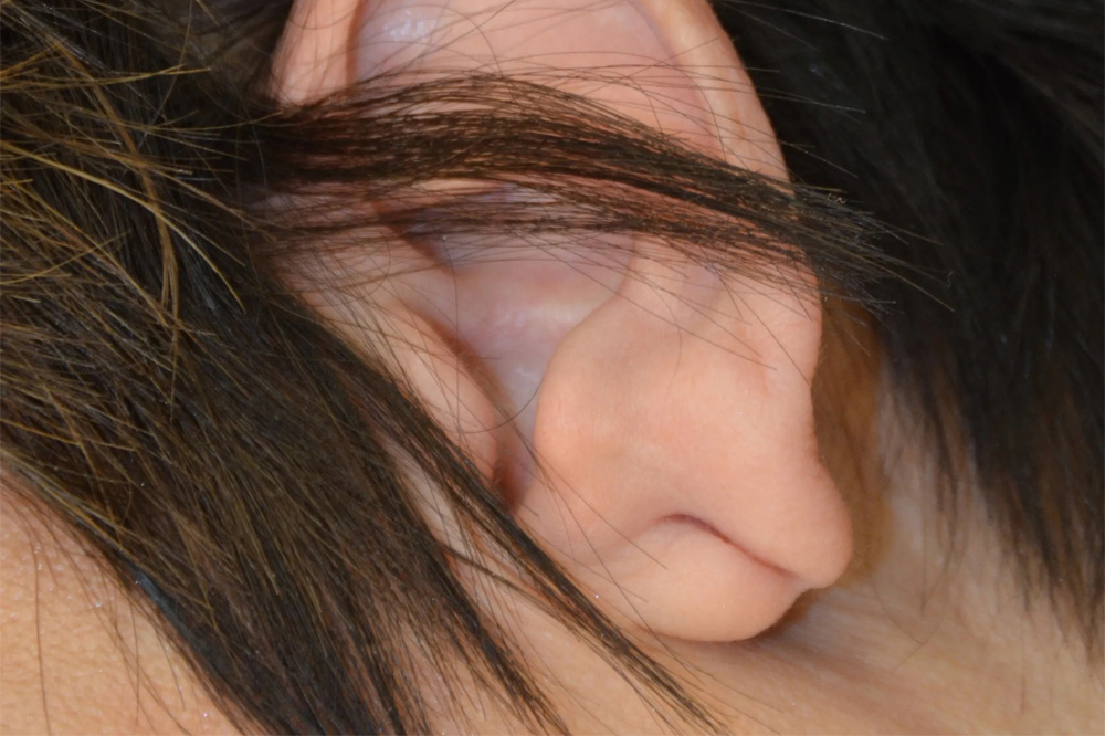 Ear Surgery Real Patient Results by Dr. Scott Urban in Salt Lake City, Utah