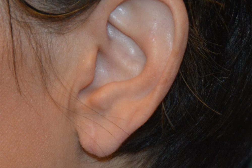 Ear Surgery Real Patient Results by Dr. Scott Urban in Salt Lake City, Utah