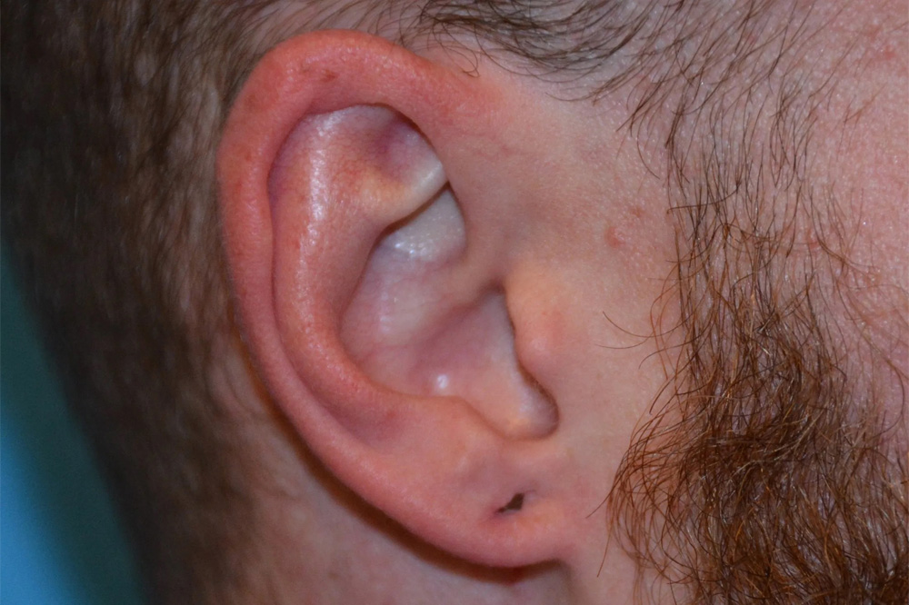 Ear Surgery Real Patient Results by Dr. Scott Urban in Salt Lake City, Utah
