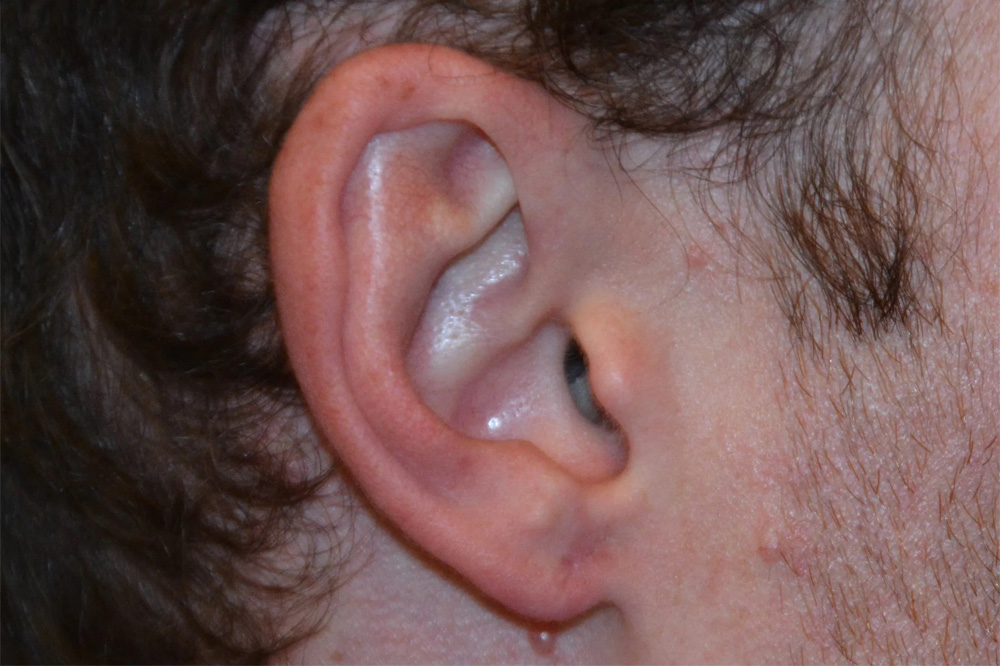Ear Surgery Real Patient Results by Dr. Scott Urban in Salt Lake City, Utah