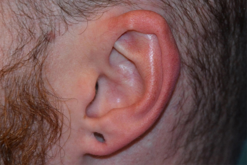 Ear Surgery Real Patient Results by Dr. Scott Urban in Salt Lake City, Utah