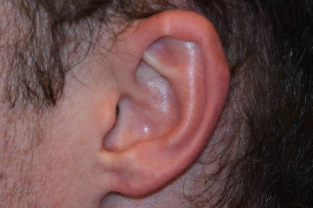 Ear Surgery Real Patient Results by Dr. Scott Urban in Salt Lake City, Utah