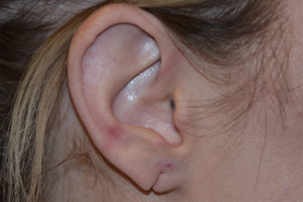 Ear Surgery Real Patient Results by Dr. Scott Urban in Salt Lake City, Utah