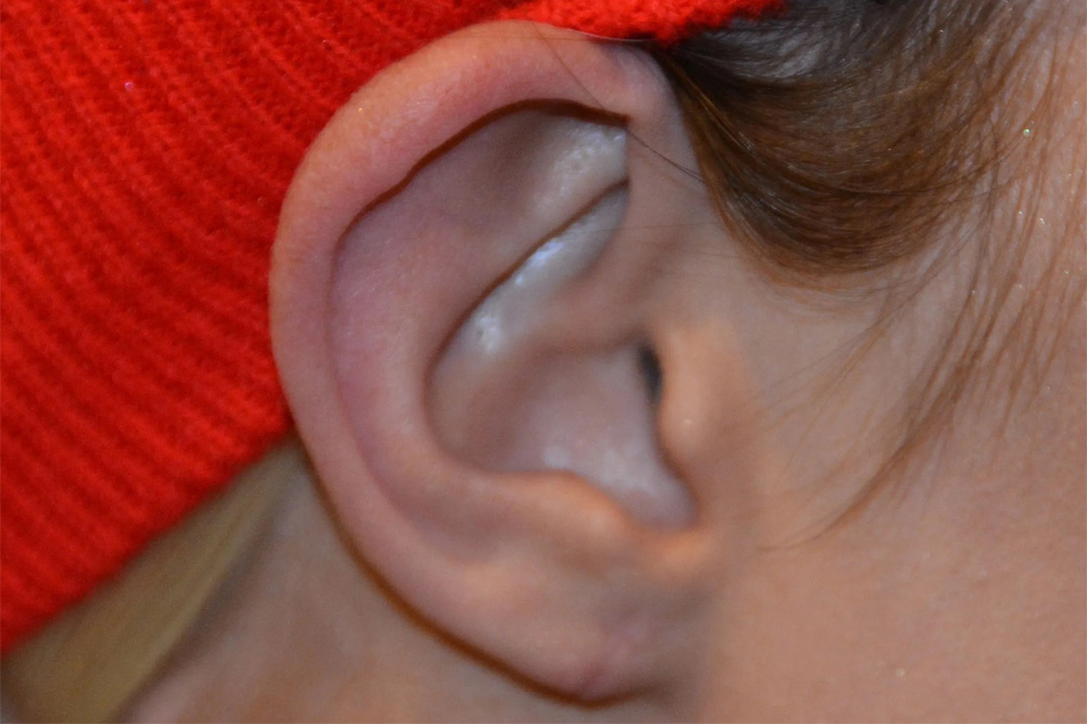 Ear Surgery Real Patient Results by Dr. Scott Urban in Salt Lake City, Utah