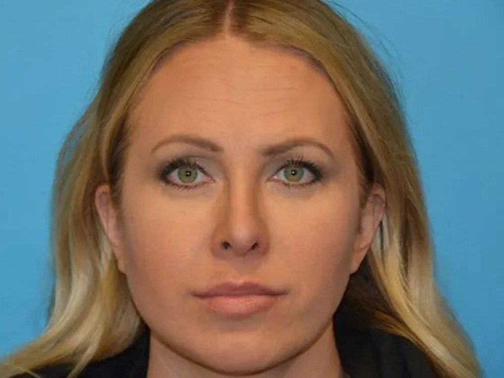 Cheek Implants Real Patient Results by Dr. Scott Urban in Salt Lake City, Utah