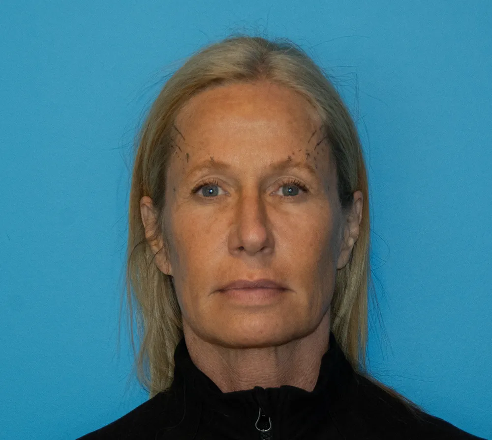 browlift 29876 1 of 6