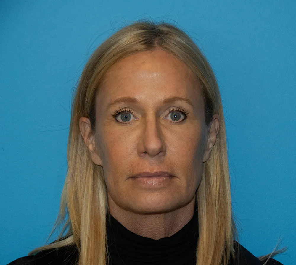 browlift 29876 2 of 6