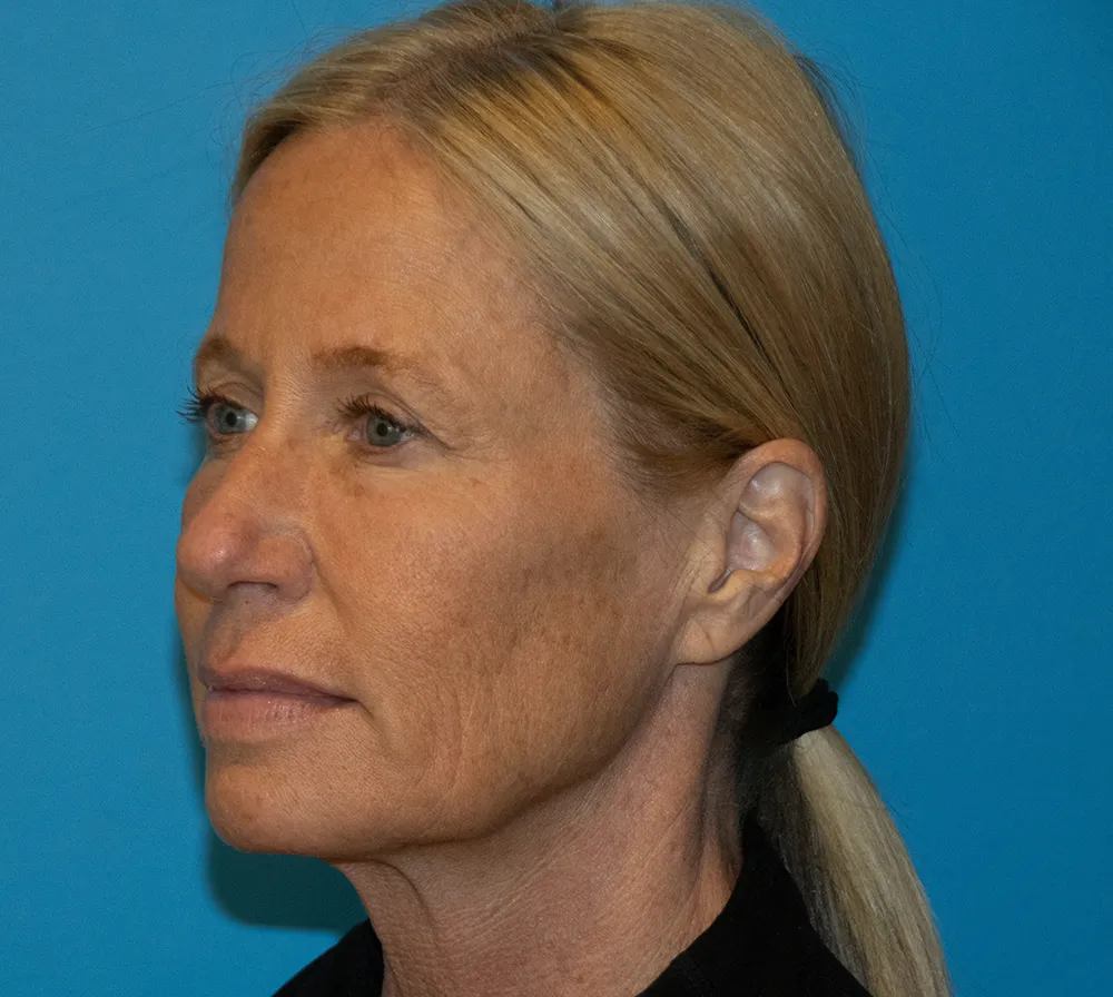 browlift 29876 3 of 6