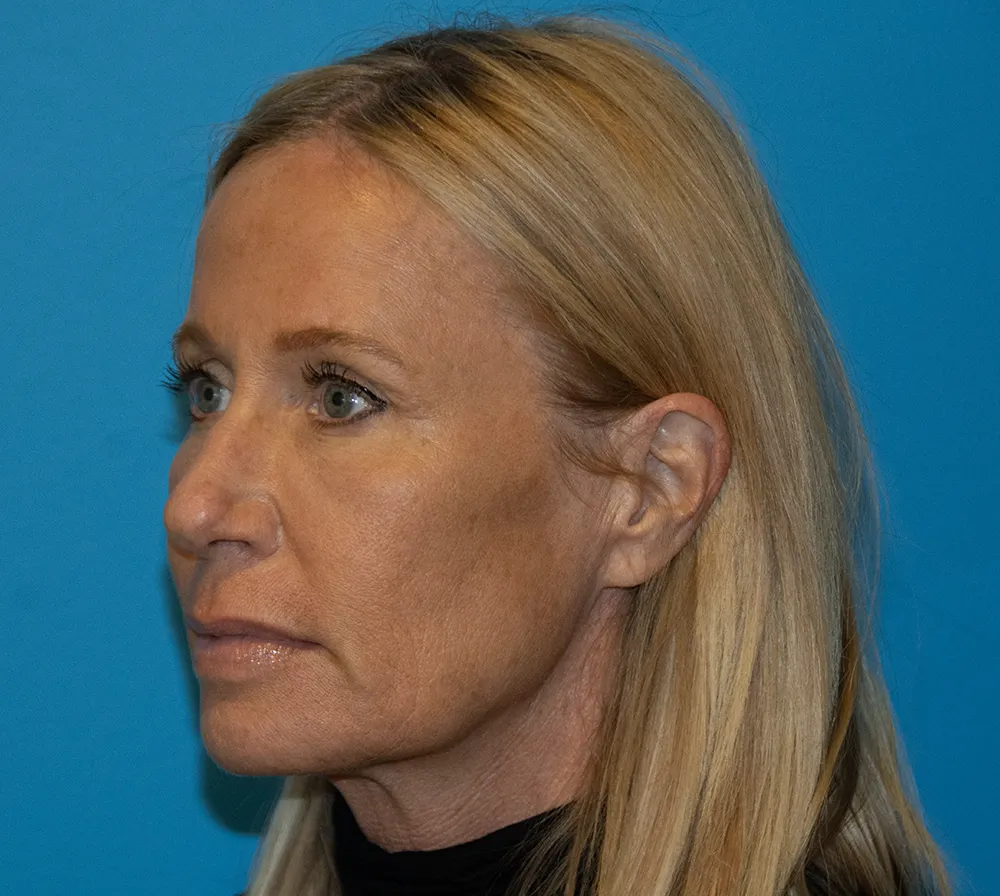 browlift 29876 4 of 6